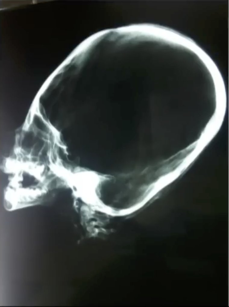 In july of 2017, a huaquero named tony sanchez attempted to sell this abnormal skull said to be discovered around the nazca-palpa region 👷🏾🏴‍☠️

#nazcamummies #medtwitter #disclosure #宇宙人 #ufox #ufotwitter