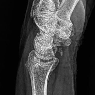 themskarchive's tweet photo. 17/4/2024. 👋🟢 HA calcium deposits can also appear in capsular planes, not only in tendons or bursae, as in this example:
Volar radiocarpal calcific periarthritis.
#XRAY and #Ultrasound correlation. #MSK #traumatwitter #orthotwitter https://t.co/vvyjkcf26X