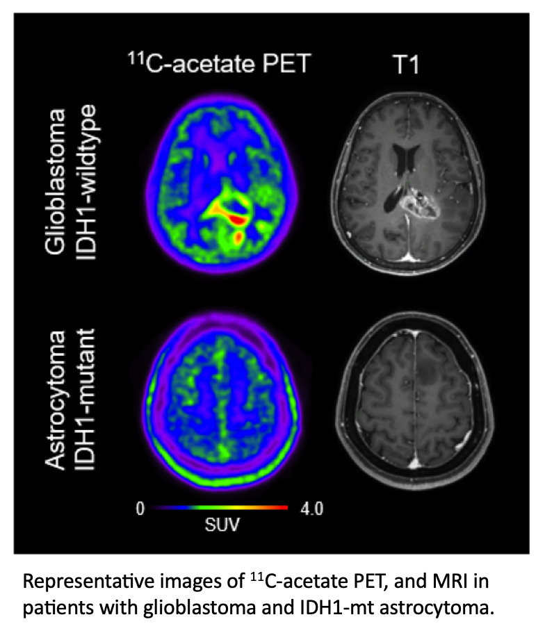 PET Imaging Technique Depicts Glioblastoma Tumor Microenvironment Learn more ➡️ bit.ly/437nM2f #RadOncEd #BrainCancer #HeadAndNeckCancer #OHANCAW #CancerAwareness #PETImaging #Glioblastoma