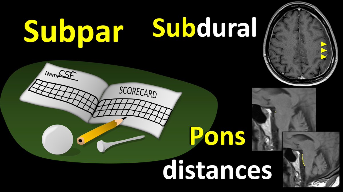 1/CSF leaks are controversial! Some say they're overdiagnosed, others ...