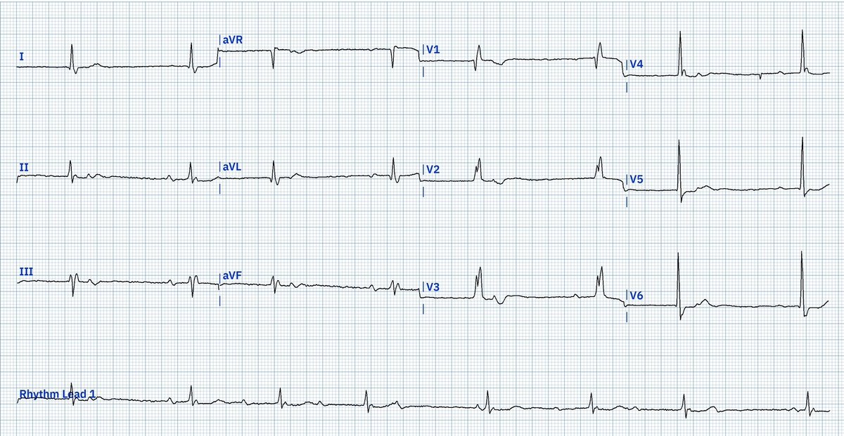 In the words of @ekgpress 'Not all patients read the textbook' Describe the rhythm/type of AV block in this ECG below ⬇️ If you fully understand each beat in this rhythm, you have a great grasp on rhythm interpretation - give it ago