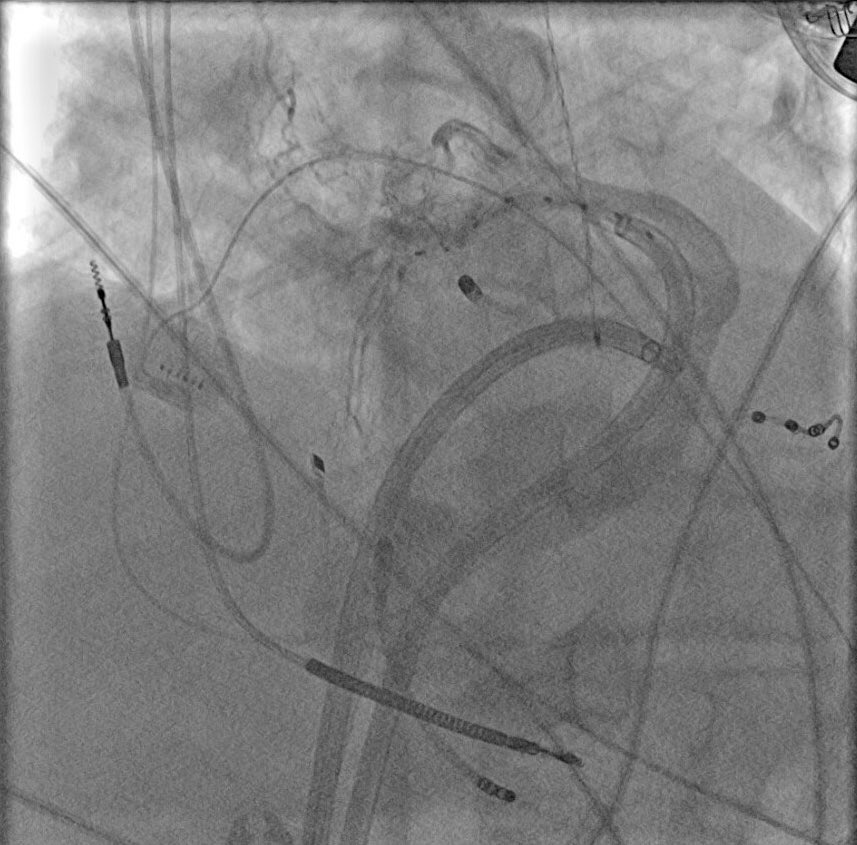 Fergie J. Losiniecki, MD, FACC, FHRS (@fergielosiniec1) on Twitter photo Case conference next week <a href="/MUSC_EP/">MUSC Electrophysiology</a> let’s go! <a href="/dhakalbish/">Bishnu Dhakal MD FHRS</a> <a href="/JRWinterfield/">Jeffrey Winterfield</a> @MiguelVldrbno <a href="/True_EP/">William H. Sauer, MD</a> Case conference next week <a href="/MUSC_EP/">MUSC Electrophysiology</a> let’s go! <a href="/dhakalbish/">Bishnu Dhakal MD FHRS</a> <a href="/JRWinterfield/">Jeffrey Winterfield</a> @MiguelVldrbno <a href="/True_EP/">William H. Sauer, MD</a>