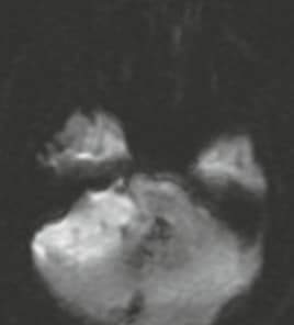 16-year-old with medulloblastoma Wnt-Subtype (Wingless)!
#Neuroradiology