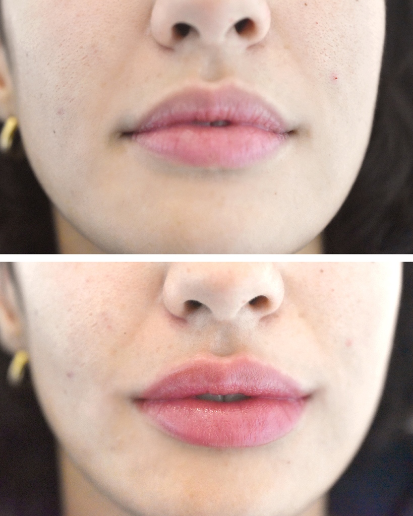 Achieve naturally plump and moisturised lips with the amazing results of lip filler treatment. 💧⁠

By stimulating the production of your own hyaluronic acid reserves, the use of hyaluronic acid filler will enhance the hydration of your lips.

#lipfiller #dermalfiller #filler