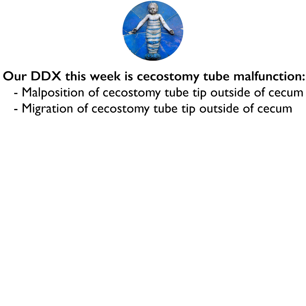 Our differential diagnosis this week is cecostomy tube malfunction - Malposition of cecostomy tube tip outside of cecum - Migration of cecostomy tube tip outside of cecum Learn more: pediatricimaging.org/ddx/differenti… #FOAMed #FOAMPed #FOAMRad #MedEd #PedsRad #RadEd #RadRes #radiology