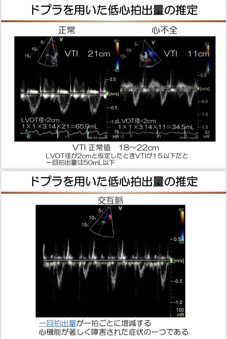 スライド供養〜初心者向け〜

心エコーにおける心拍出量(CO)、一回拍出量(SV)の出し方

Teichholz法は径を3乗しているので少しのズレで大きく変わる→なので計測は正確にする必要がある
LVOTも2乗するので注意が必要
LVOTのパルスドプラ波形やVTI値にも注目
(ディスク法の🥏がガタガタなのはご愛嬌)