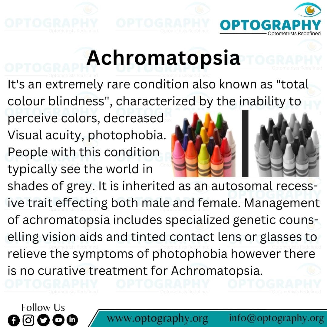 Achromatopsia: a rare genetic disorder causing total color blindness, usually evident within the first two weeks of life and lasting a lifetime.
#Achromatopsia #ColorBlindness #GeneticDisorder #MedicalCondition #HealthAwareness
#Optometry #Optography