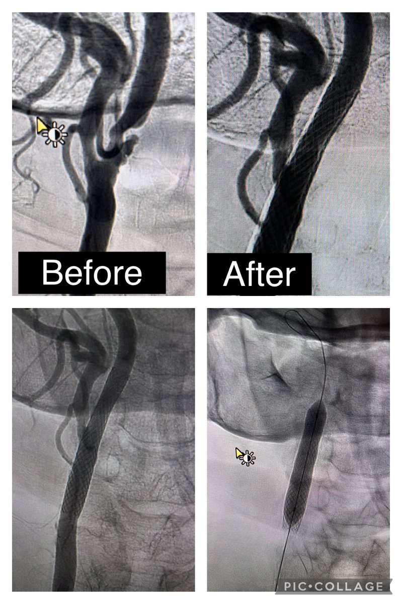 Just finished this carotid stenting to treat this symptomatic ulcerated plaque, F 80YO. #stroke #NIR #angioplasty
