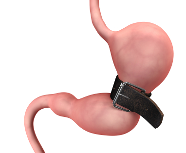 Hypnosis gastric band: clinicalhypnotherapy-cardiff.co.uk/gastric-band-h…

#highbloodpressure #hypertension #heartdisease #stroke #arthritis #cancer #infertility #diet #slim #bodypositive #slimming #tips #therapy #health #anxiety #treatment #visualisation #relax #lifestyle