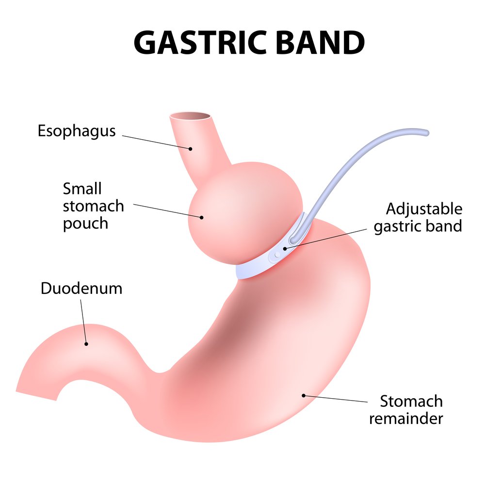 Hypnosis gastric band: clinicalhypnotherapy-cardiff.co.uk/gastric-band-h…

#wellbeing #mindfulness #healing #wellness #complementary #alternative #natural #holistic #clinic #hypnosis #hypnotherapy #hypnotherapist #hypnotist #Cardiff