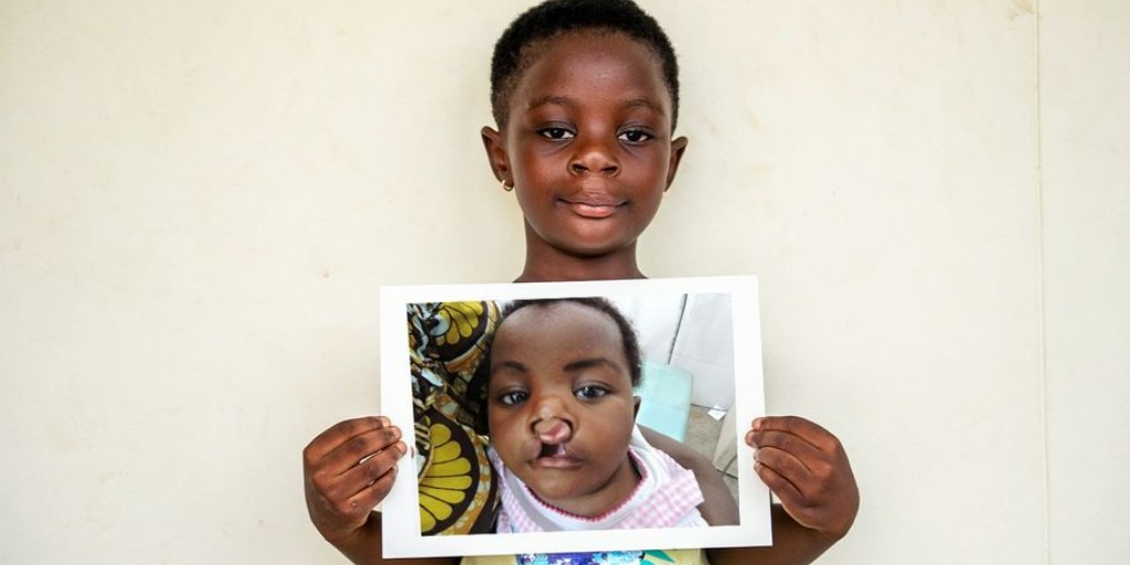 Meet Ama from Ghana! Ama was born with a cleft lip and palate. Thanks to Smile Train's support, she received free cleft surgery and comprehensive care at Komfo Anokye Teaching Hospital. Now at 6, she is thriving!