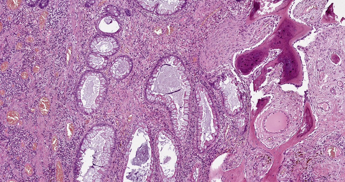Metaplastic ossification in the hamartomatous rectal polyp, pretty rare condition #GIpath #dpathology #unim #polyposis #rectum