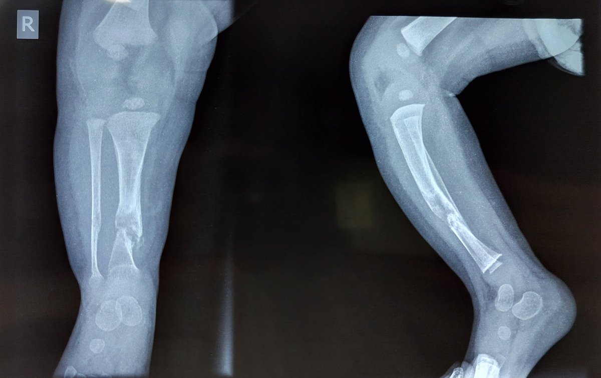 #cystic type #congenital #pseudarthrosis of #tibia. 

At 2 months of age....

What's your choice ?? 

Poll below 

#fracture 
#child 
#orthotwitter 
#medtwitter 

👇👇 Poll