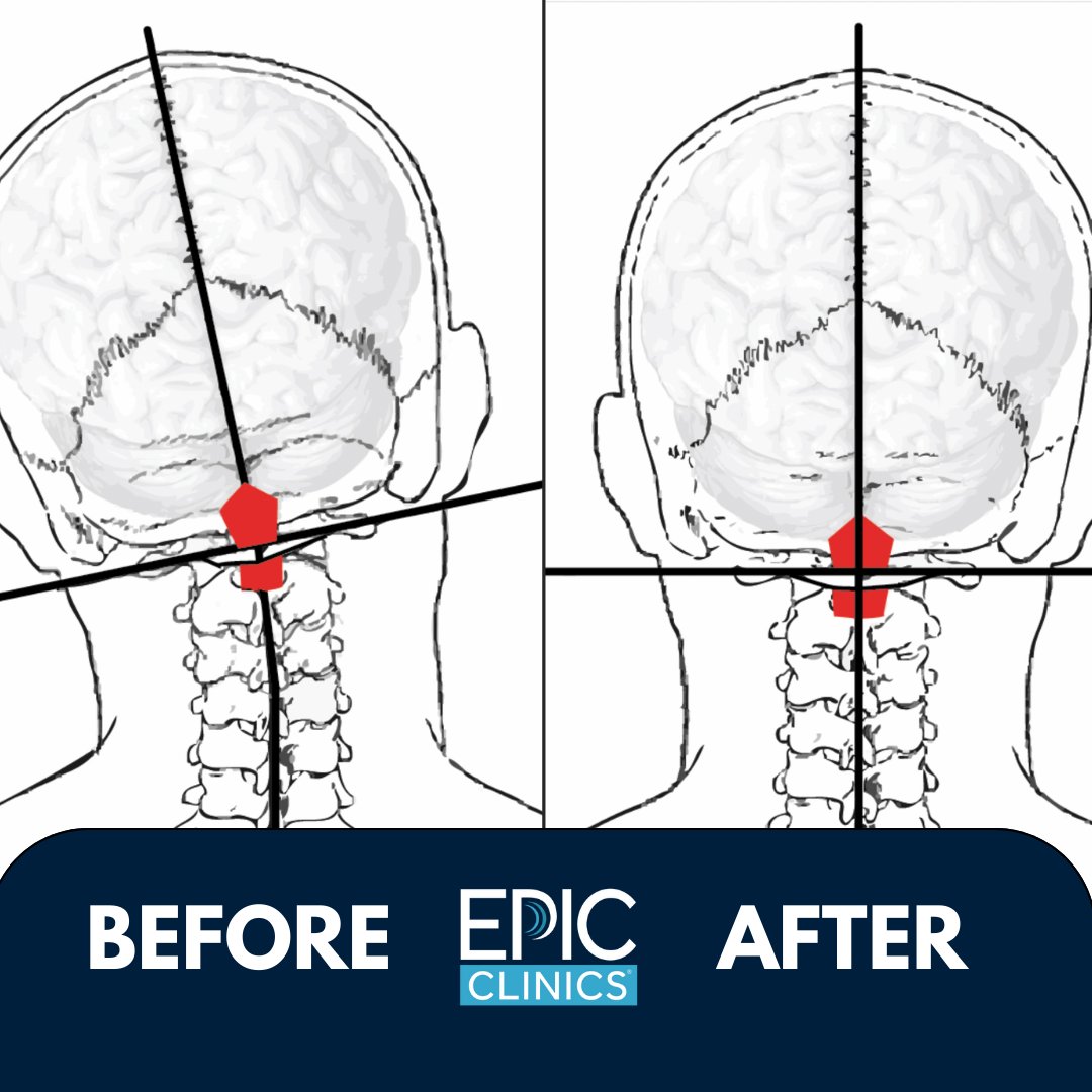 The results truly speak for themselves. 

Is your head on straight? EPIC can help. 

#SpineHealth #BrainHealth #UCCare #UpperCervicalCare #EPICClinics