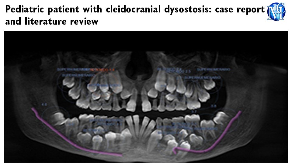 #Pediatric #patient with cleidocranial dysostosis: case report and literature review published in MOJ #Orthopedics & #Rheumatology by Hugo Romero, et al. medcraveonline.com/MOJOR/MOJOR-16… #syndrome #science #pathology #biology