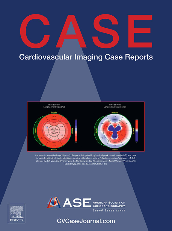 Our April 2024 @CASEfromASE is online! bit.ly/3EZ3nlI This issue features: 🫀Blueberry-on-Top Phenomenon in Apical Variant HCM 🫀Isolated Traumatic Membranous Interventricular Septal Rupture 🫀Cor Triatriatum Dexter & Right Atrial Mass Causing Severe Inflow Obstruction