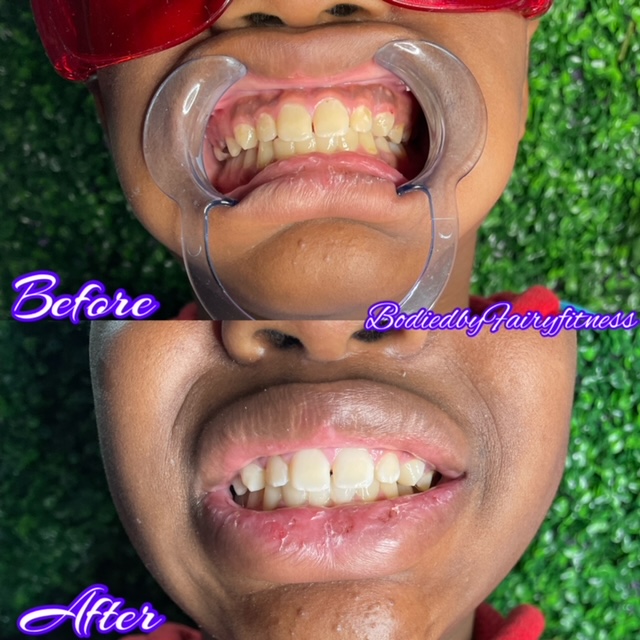 Transforming smiles, one session at a time! Check out the remarkable before and after results of our teeth whitening session. Brighten your smile and boost your confidence with Bodied by Fairy Fitness! #bodiedbyfairyfitness #indyspa #selfcare #indymoms #confidencebooster