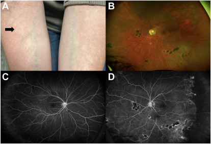 Unilateral Retinopathy from Incontinentia Pigmenti ow.ly/y36750QYBkU