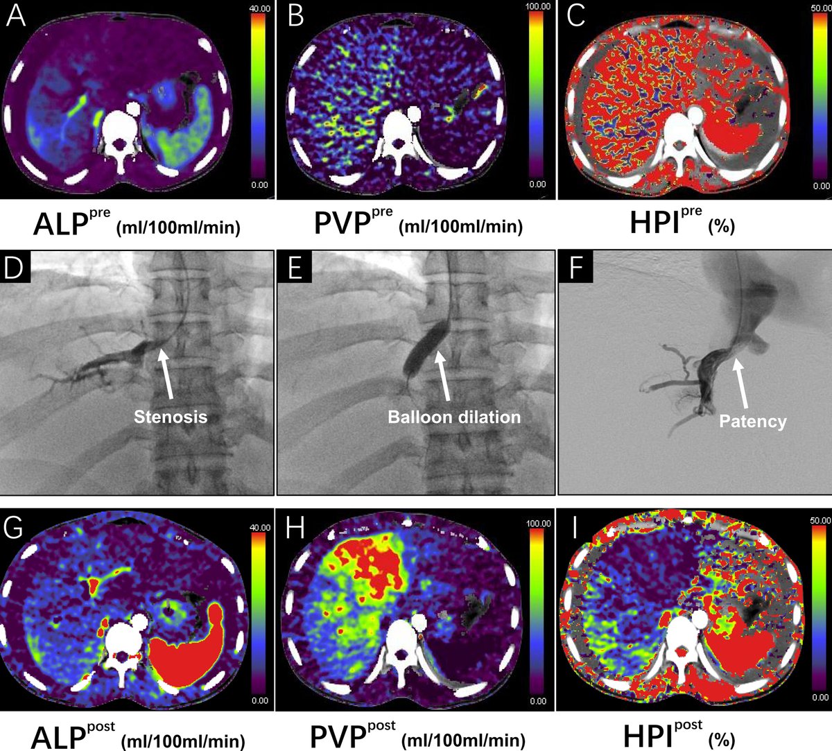 CT images before interventional therapy show reduced arterial liver perfusion, decreased portal venous perfusion, and elevated hepatic perfusion index. DSA confirmed stenosis of left hepatic vein and successful restoration of vessel patency. bit.ly/4aCi6QD