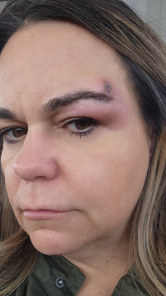 braundasmith's tweet photo. @QPsyOps This is my brown recluse bite experience! 10 otta 10 do not recommend! https://t.co/SAskAndHqL
