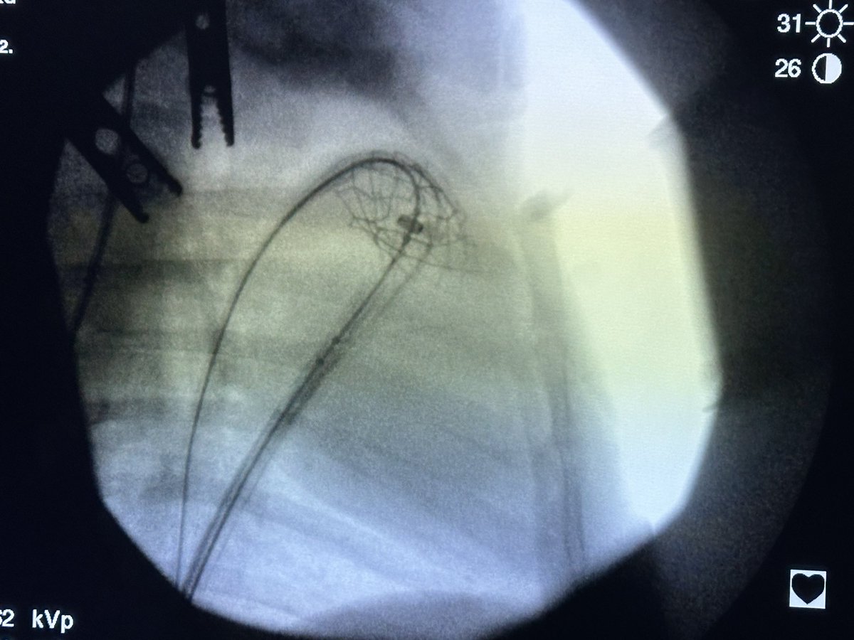 ArashKheradvar's tweet photo. Another successful #IRISValve implantation today! Thanks to our great team! #TPVR https://t.co/wjRCO2BvpW
