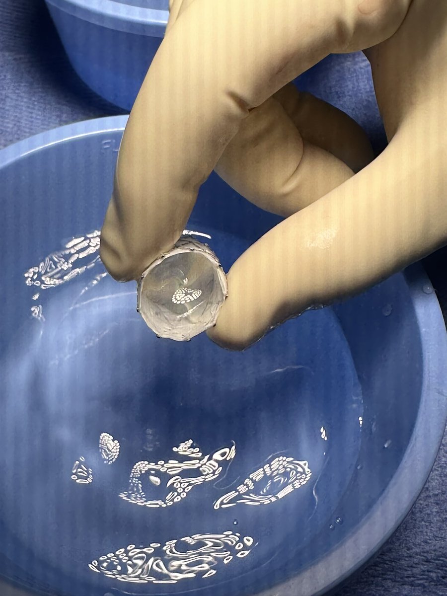 ArashKheradvar's tweet photo. Another successful #IRISValve implantation today! Thanks to our great team! #TPVR https://t.co/wjRCO2BvpW