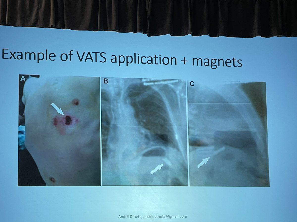 Fascinating talk by Dr Andrii Dinets on the use of VATS for thoracoabdominal penetrating injuries in Ukrainian Role II facilities, including purpose-built magnets during VATS to remove 50% of liver fragments and 80% of lung fragments. #sages2024