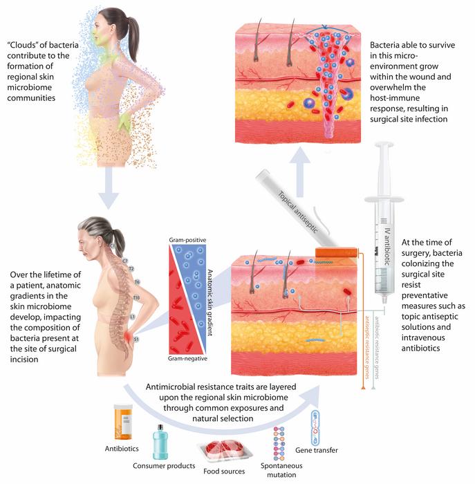 Why are surgical #infections still common, despite strict sanitation protocols?

A genomics study of spinal surgery recipients shows many infections originate from the patient’s own skin #microbiome rather than contamination. @ScienceTM scim.ag/6CY