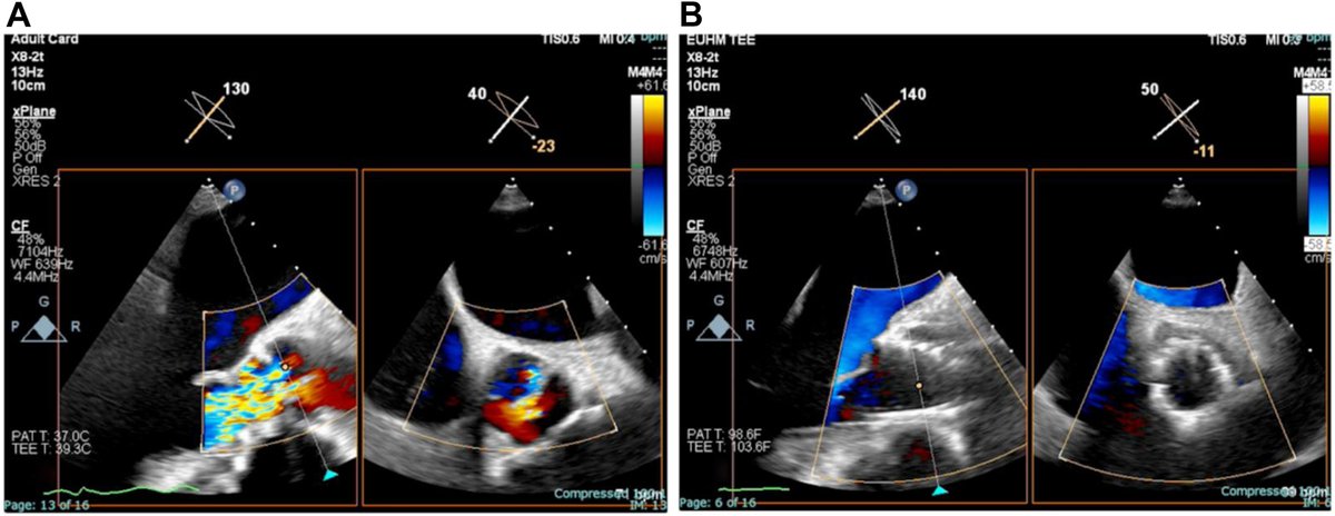 🔖Double BASILICA + #TAVR successfully performed in quadricuspid aortic valve w severe regurgitation at risk of coronary obstruction resulting in resolution of symptoms. #Basilica ➡️doi.org/10.1016/j.jsca… @BabaliarosArgos @AdamGreenbaumMD