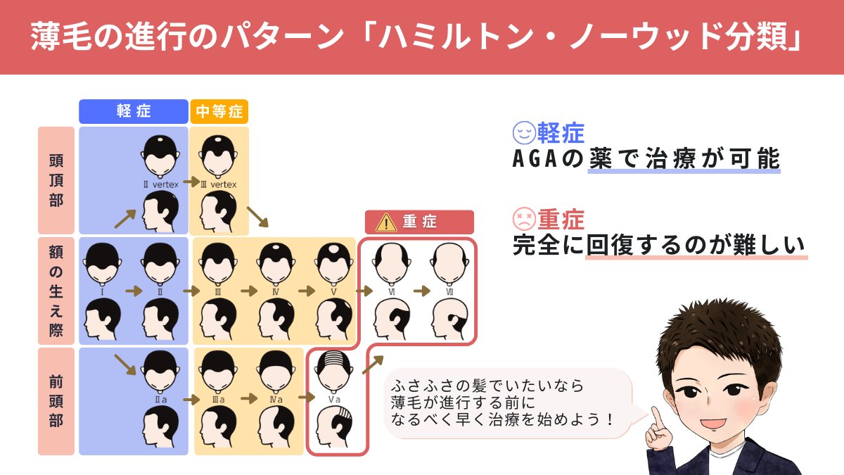 絶対に知っておいて。男性薄毛の９割以上の【AGAは進行性の病気】です。薄毛の進行のパターンは「ハミルトン・ノーウッド分類」で分けられる。軽度だとAGAの薬で治療できる。でも、重度になると完全に回復するのは難しい。ふさふさの髪でいたいなら、薄毛が進行する前に、なるべく早く治療を始めよう！