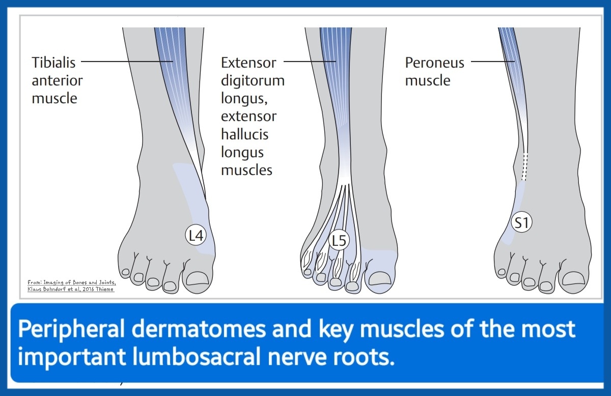 Peripheral dermatomes & key muscles of the most important lumbosacral nerve roots. However, keep in mind that the muscles also receive contributions from other nerves (e.g., the extensor digitorum longus is innervated mainly by L5, but also from L4 and S1).