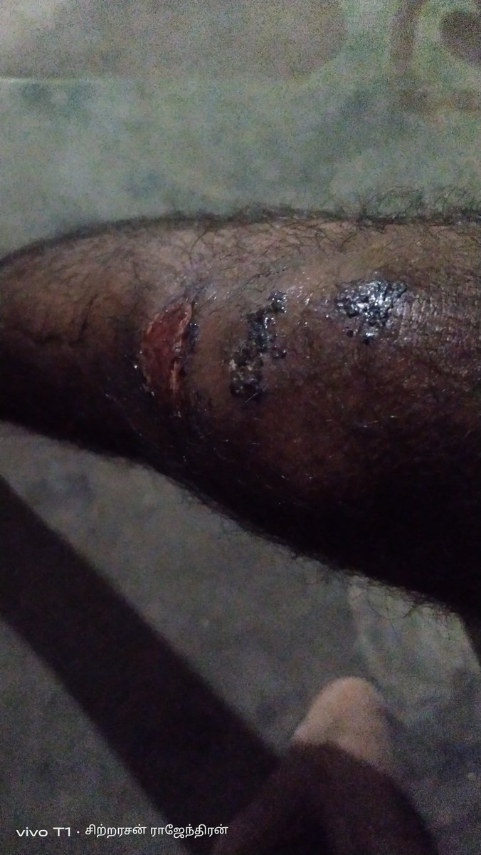 IamSittrarasan's tweet image. காலில் காயம் உள்ள போதும் ஊர் முழுவதும் சென்று #மாம்பழம் சின்னத்திற்க்கு வாக்கு கேட்ட @IamSittrarasan இவரை பாராட்டலாமே ப்ரண்ட்ஸ்....
💙💛❤️

#VoteForMango 🥭
#நமதுசின்னம்மாம்பழம்