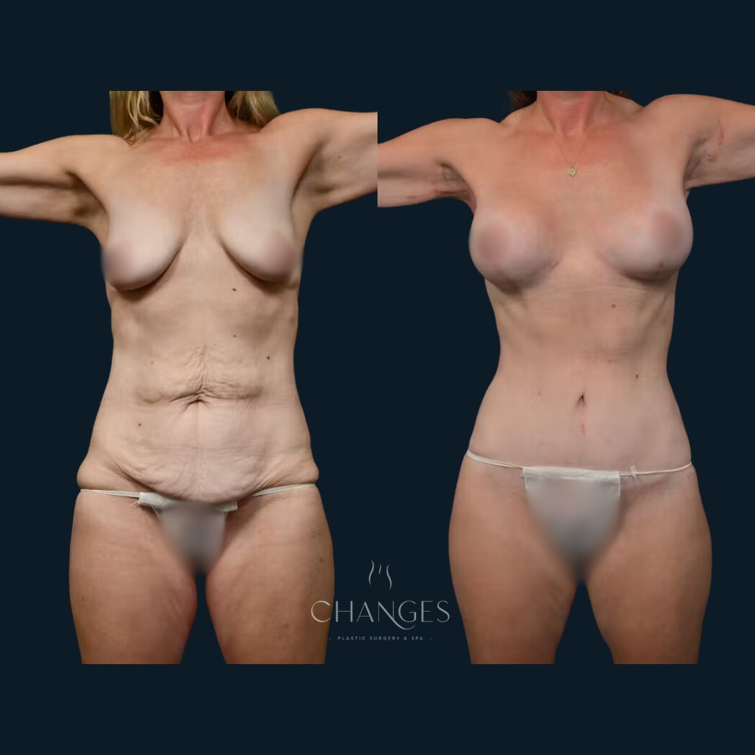 ChangesPlastic's tweet photo. This gorgeous mother of 2 little ones had a breast lift, tummy tuck, liposuction, fat transfer, and an arm lift to achieve her dream body.

Ready to start your journey? Book a consultation at the link below. 

https://t.co/gVb7VwqzrO https://t.co/fKsfFilpJW