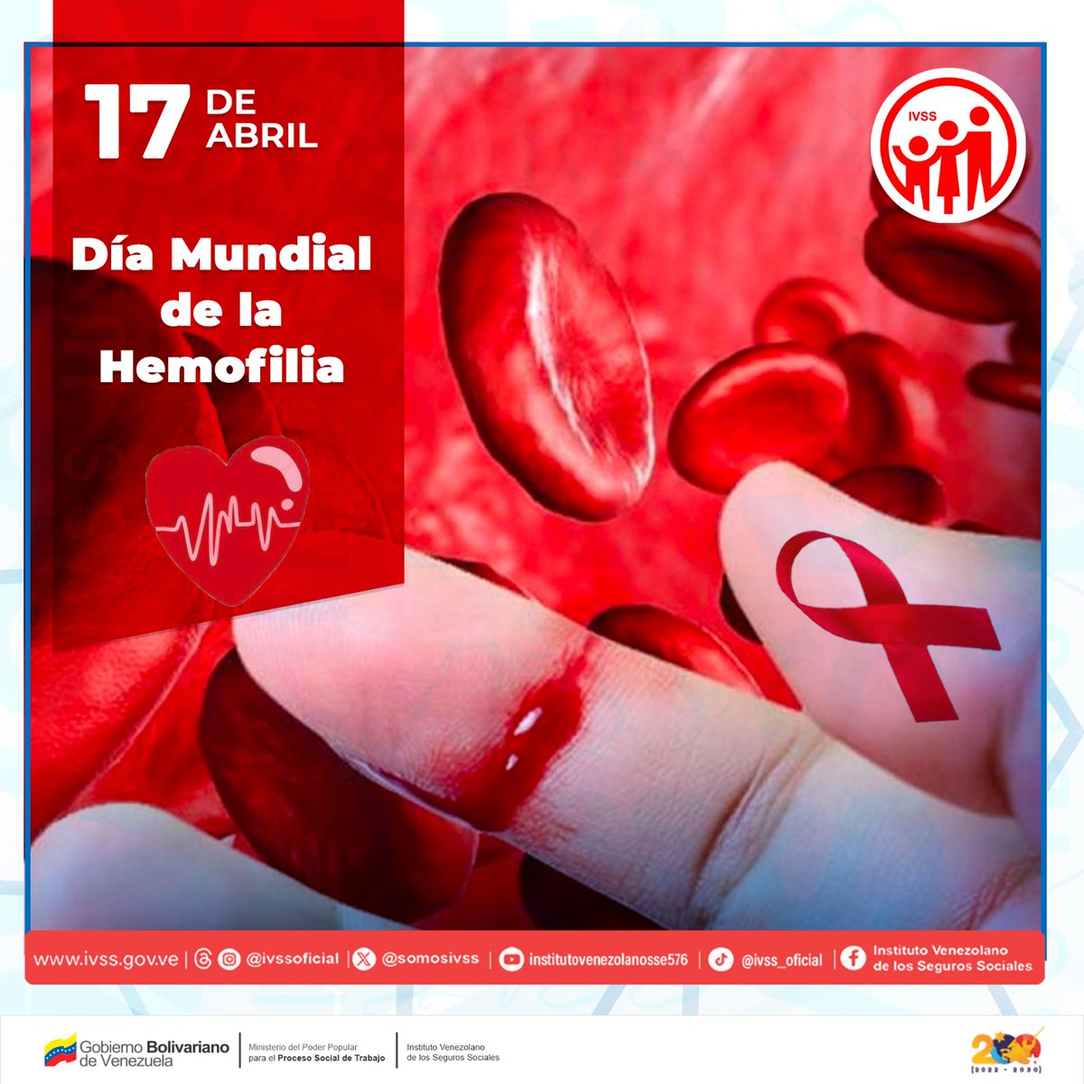 Hoy en el Día Mundial de la Hemofilia, es un trastorno hemorrágico hereditario que se caracteriza por la dificultad de la sangre para coagular, esto puede ocasionar hemorragias espontáneas. #VenezuelaSeRespetaYPunto @MagaGutierrezV @NicolasMaduro @delcyrodriguezv @conciliaflores