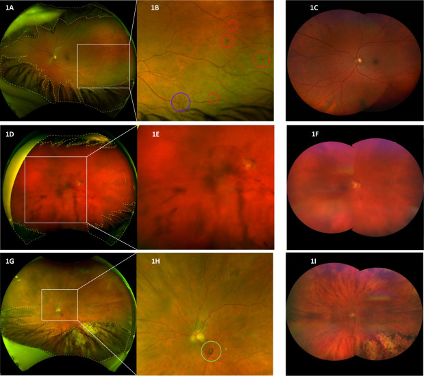 Peripheral and Vitreous Pathology in Ultrawide Field Cameras in Diabetic Eyes ow.ly/kk1B50QYBmz