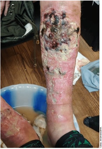 “Skin rotting.” “Flesh destroying.” “Zombie drug.” The headlines about the drug xylazine sound apocalyptic. But @poisonreview wonders if these claims are based on science or are they arble-garble? Here’s what he found. tinyurl.com/49sf3vn9 #FOAMed
