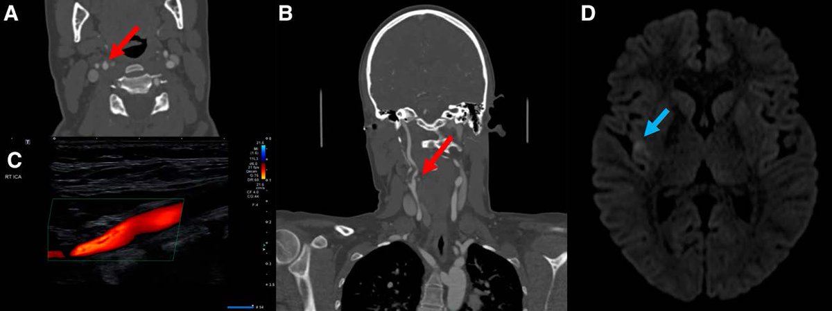 #Stroke Images by Mutimer and Campbell showcases a rare cause of thromboembolism — direct carotid artery compression by the hyoid. #AHAJournals ahajournals.org/doi/10.1161/ST…