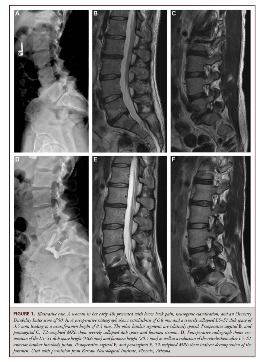 Check this out from Turner et al., @BarrowNeuro published in the latest Operative Neurosurgery: Radiographic and Clinical Outcomes After Stand-Alone ALIF for L5-S1 Retrolisthesis @CNS_Update @NeurosurgeryCNS @DKondziolkaCNS @thejuansuribe journals.lww.com/onsonline/abst…