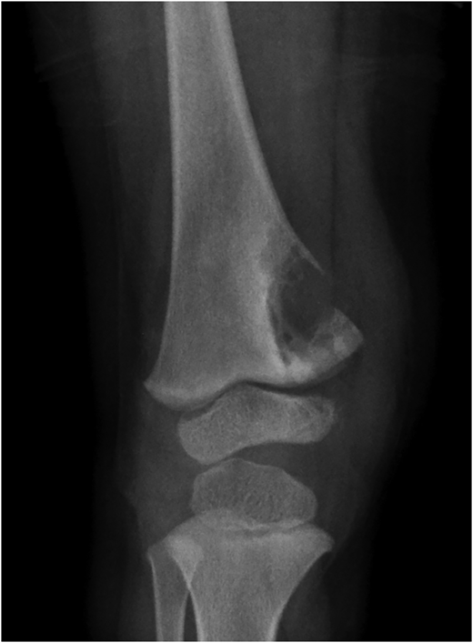 #PediatricsInReview | A Lytic Bone Lesion in a 23-month-old Boy from Kenya: bit.ly/4asnllX