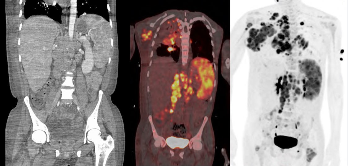 AshtonDrakeHall's tweet photo. 🚨DIAGNOSTIC DILEMMA🚨
Patient dx with tuberculosis 3 months after immigrating to the US. CT showed multifocal lymphadenopathy. Repeat PET/CT scans below. Axillary LNB revealed CD15+, CD30+ cells.
Dx?
Read our case here: https://t.co/NtdF92xxOW
@IDAdvance #IDCases https://t.co/qsa7HkJ9KJ