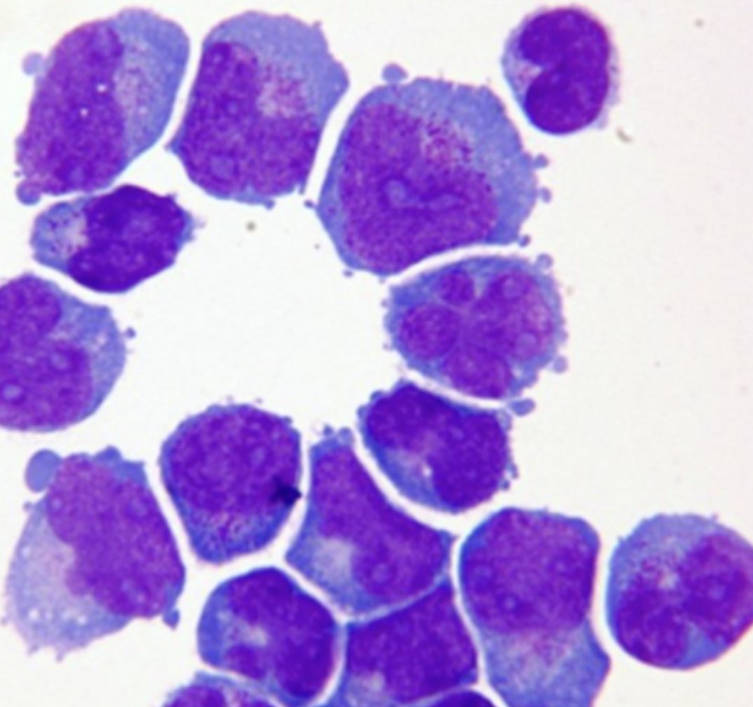 Risk factors for CNS involvement by AML - Memorize this to impress your leukemia attending! Monocytic/monoblastic APL (in relapse) FLT3 ITD mutation inv(16) Chromosome 11 abnornalities CD56+ Hyperleukocytosis at diagnosis Age<2 years Extramedullary disease