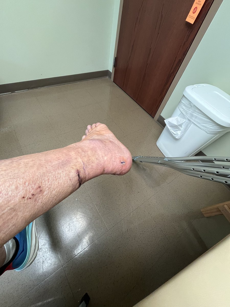 Alexander_J_Kaz's tweet image. +13 days post op, back in the boot. Rehab starts in earnest. #speedbridge #achilles #physicalrehab