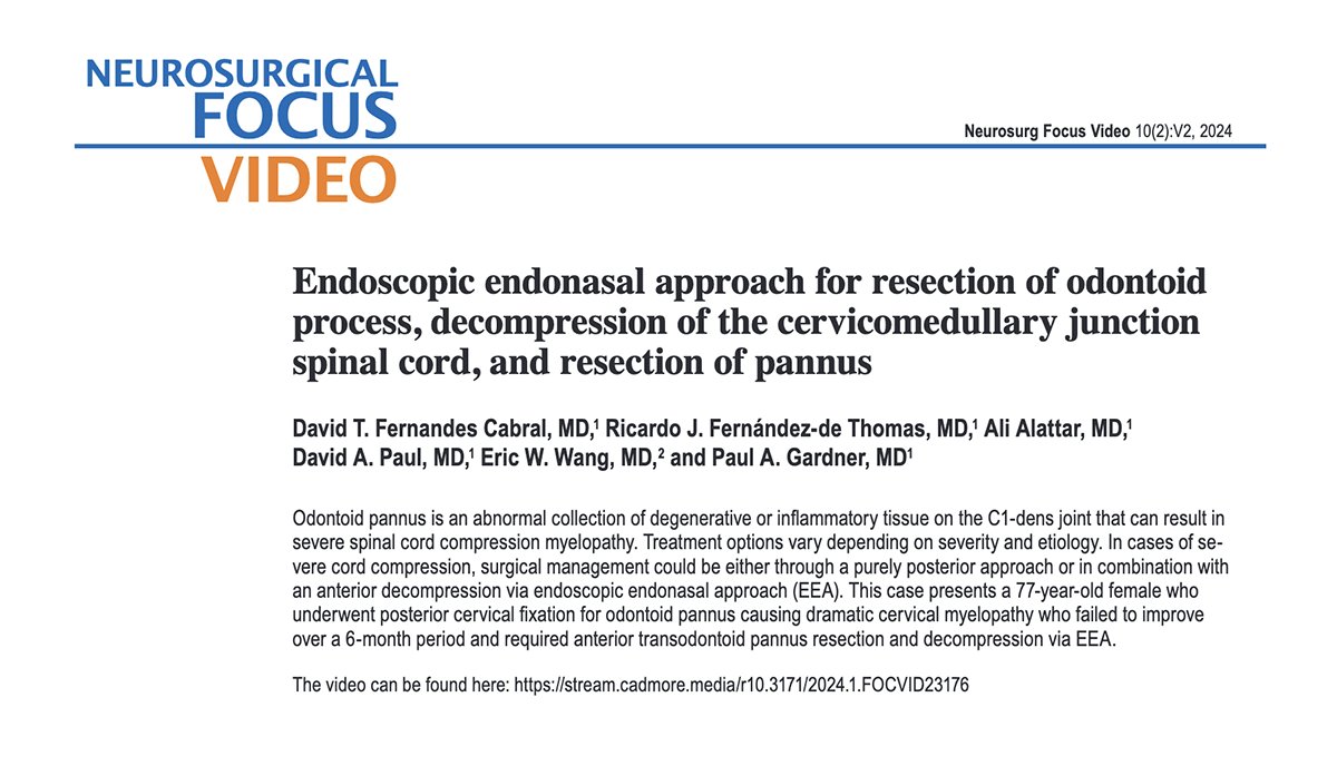 Video shows successful case of an endoscopic endonasal approach for the resection of an odontoid pannus. stream.cadmore.media/r10.3171/2024.… @SkullBaseDocs @dtfernandesc @ricardojf7 @dpaulMD @OtoPitt @UPMCPhysicianEd @PittHealthSci @TheJNS