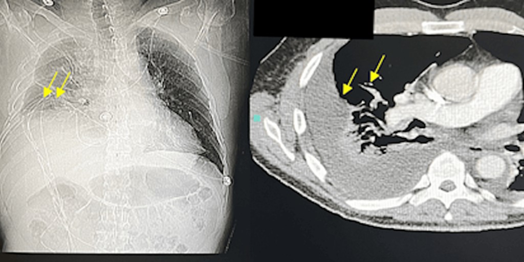 Exciting new findings in #ValleyFever research! A rare case of severe coccidioidomycosis presenting with a large pleural effusion in an immunocompetent patient. Read more: bit.ly/49CZkHy #MedTwitter #MedEd #InfectiousDisease