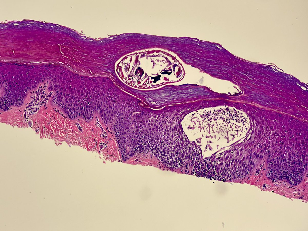 Itchy feet with this :)) ? #dermpath #dermatology