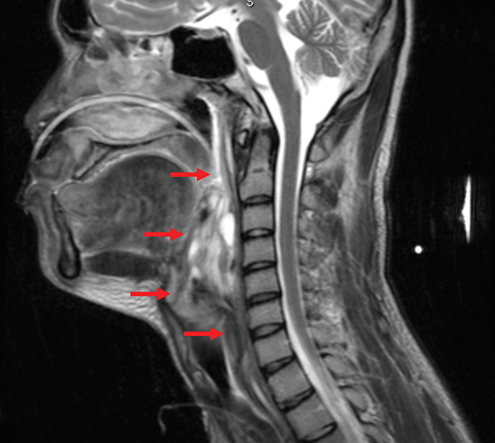 Case Study: Neoadjuvant chemoradiotherapy for laryngeal synovial sarcoma Learn more ➡️ bit.ly/3Jns6kM #RadOncEd #BrainCancer #HeadAndNeckCancer #OHANCAW #CancerAwareness #SynovialCellSarcoma