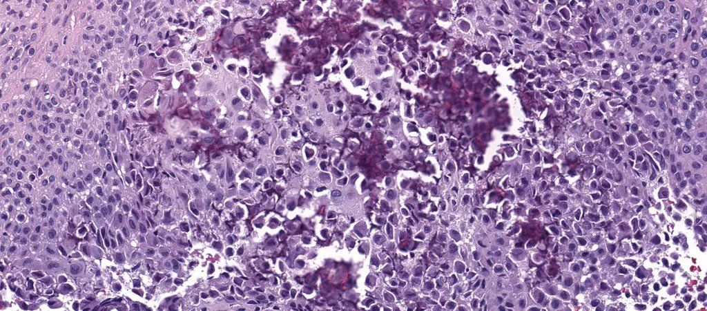 12 yo M with 3 cm prox tibia epiphyseal lytic bone lesion, demarcated w sclerotic rim. WSI digital slide: kikoxp.com/posts/4604. Answer & video: youtu.be/UX6yXjMiX9M?si… #BSTpath #radpathmatch #radiology #pathology #pathTwitter #orthotwitter