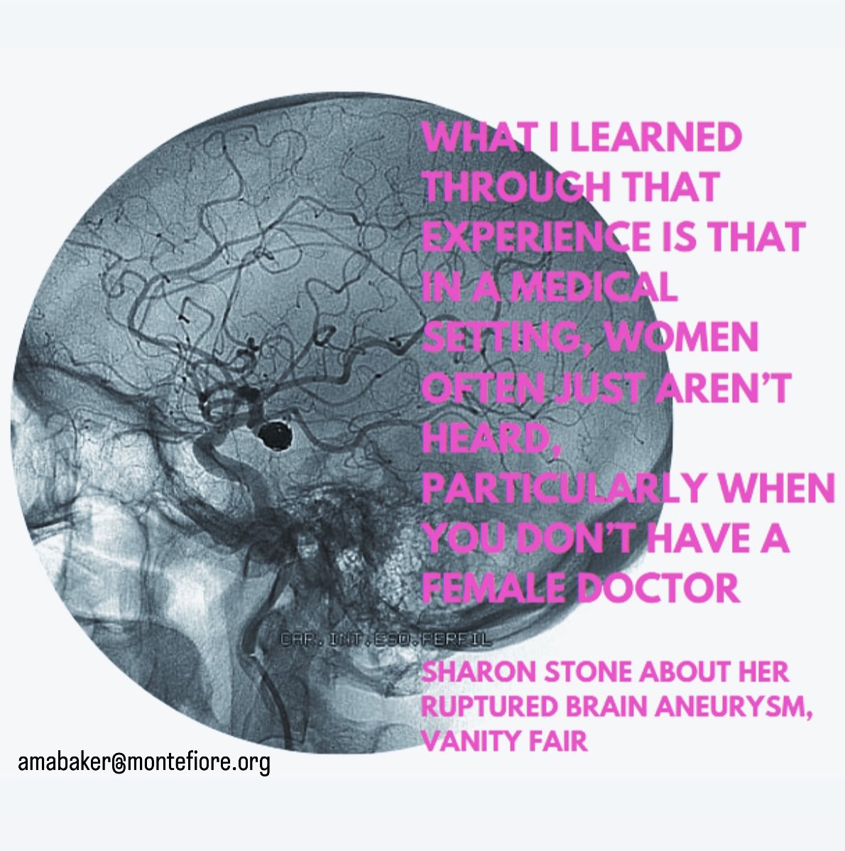 Brain aneurysms affect more women than men, but neurointervention infects more men than women.😉🧠 @WomenInNeuroIR @MontefioreNYC @MontefioreRAD @NeuroMonteEinst @MonteNeurosg