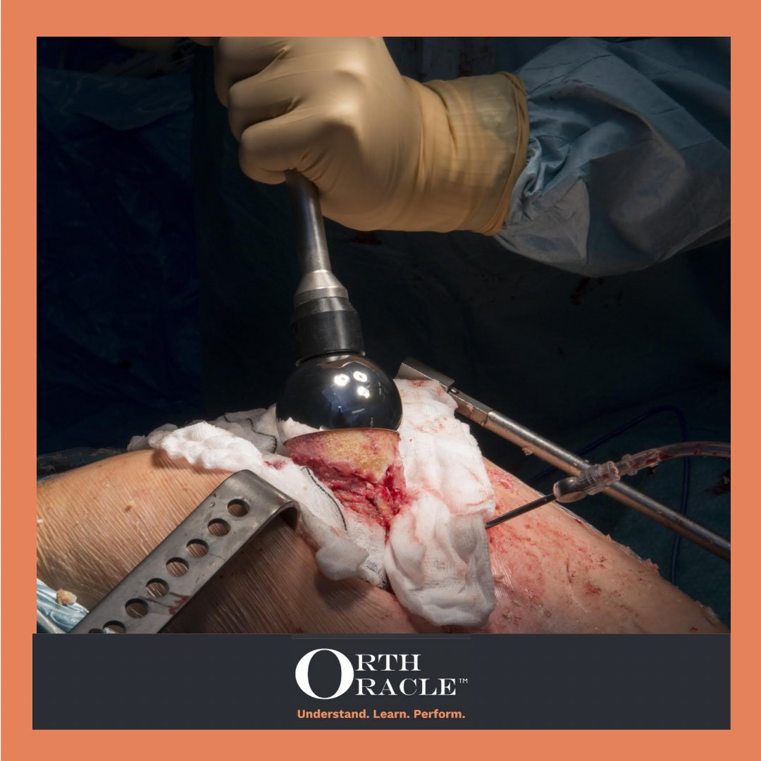 Orthoracle (@orthoracle) on Twitter photo Orthopaedic Excellence: 4th World Arthroplasty Congress Madrid April 2024
The Team <a href="/orthoracle/">Orthoracle</a> are spotlighting the World Arthroplasty Congress with focus on key topics including Robotic assisted arthroplasty & Partial knee replacement. orthoracle.com/news
#orthotwitter Orthopaedic Excellence: 4th World Arthroplasty Congress Madrid April 2024
The Team <a href="/orthoracle/">Orthoracle</a> are spotlighting the World Arthroplasty Congress with focus on key topics including Robotic assisted arthroplasty & Partial knee replacement. orthoracle.com/news
#orthotwitter