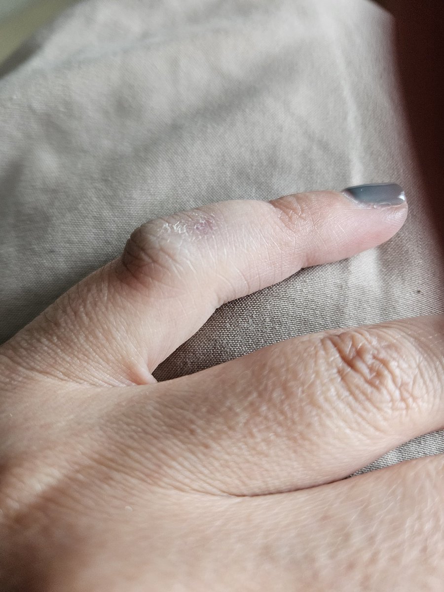 49erGirlie77's tweet photo. Do we think this looks broken?
#Ouch
#IsItBroken https://t.co/5VnfI1XKSO